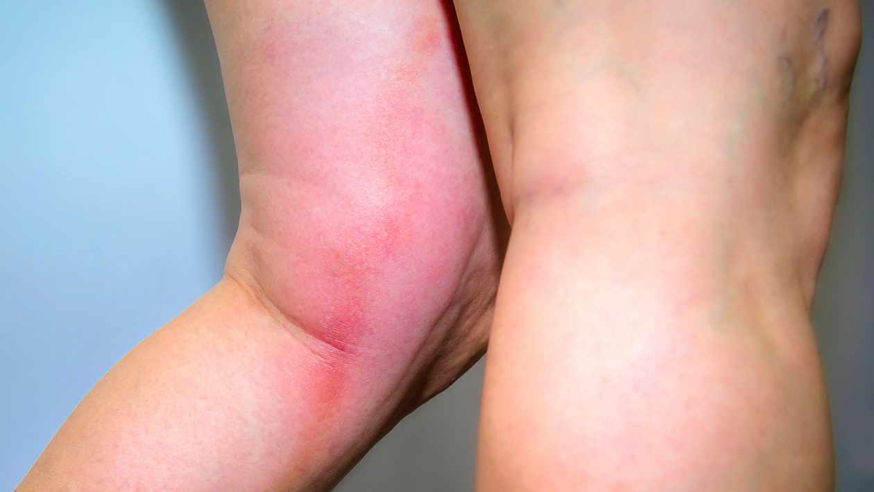 Symptoms of blood clot in leg