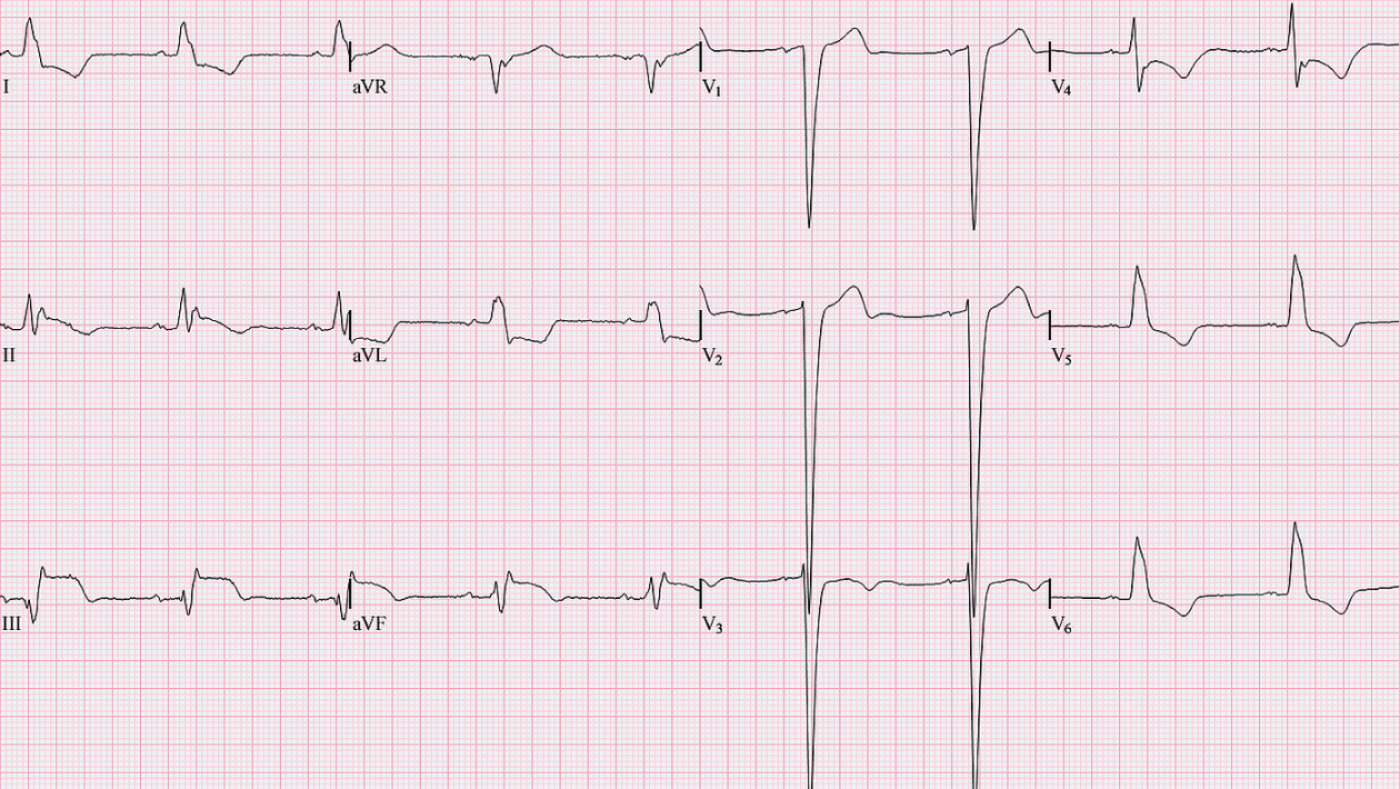 Left Bundle Branch Block