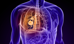 4 symptoms of lung cancer that you should be aware of